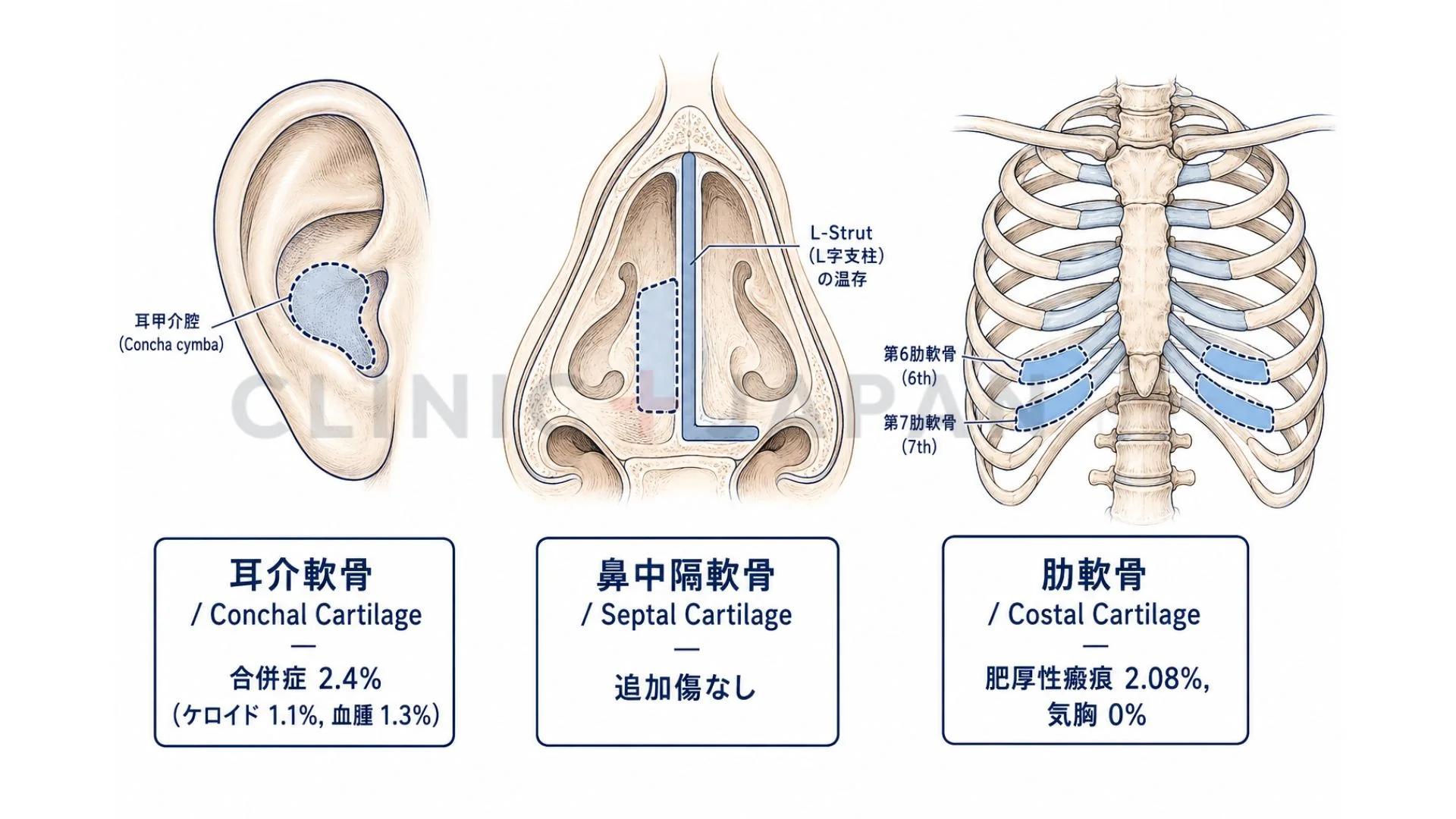 鼻孔縁下降術 軟骨素材の比較 — 耳介軟骨・鼻中隔軟骨・肋軟骨の採取部位と合併症発生率