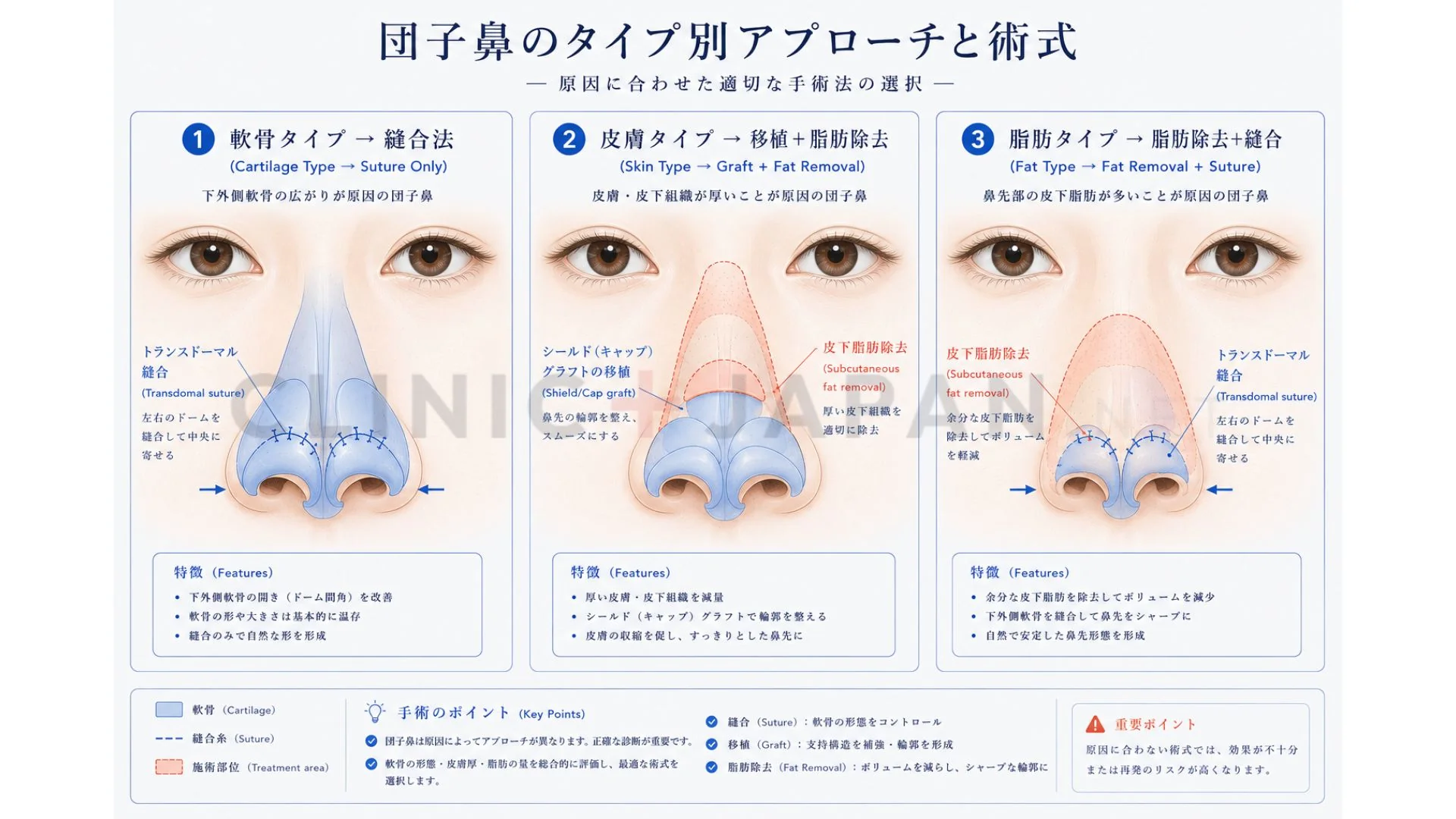 団子鼻の手術アプローチ — タイプ別の術式選択