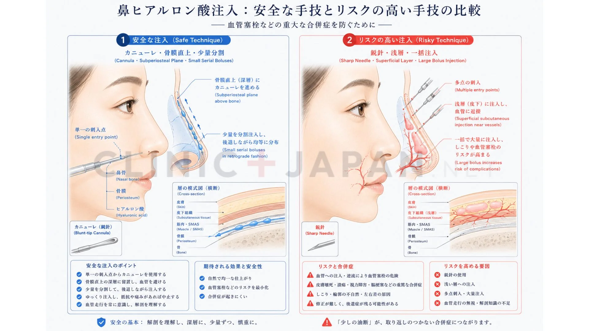 鼻ヒアル注入テクニック — カニューレ深層注入と血管回避のポイント