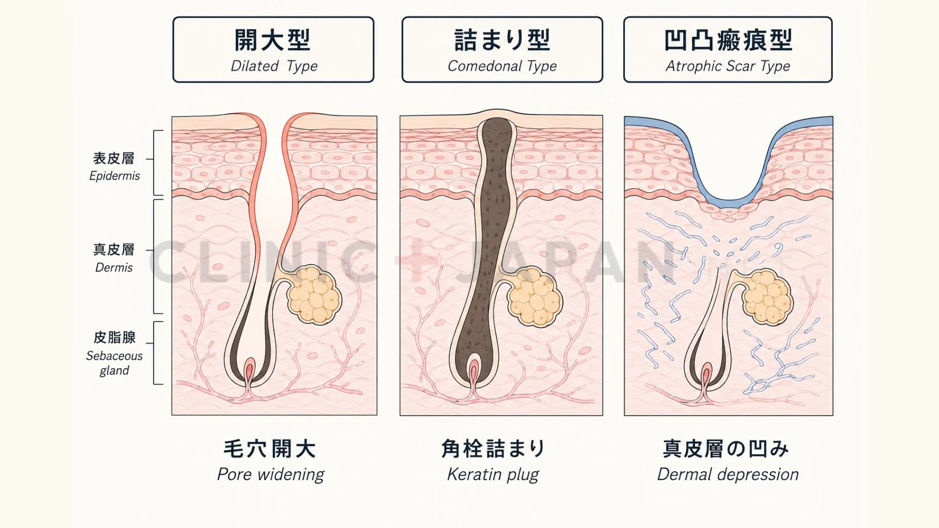 毛穴ボコボコの原因3タイプの違い