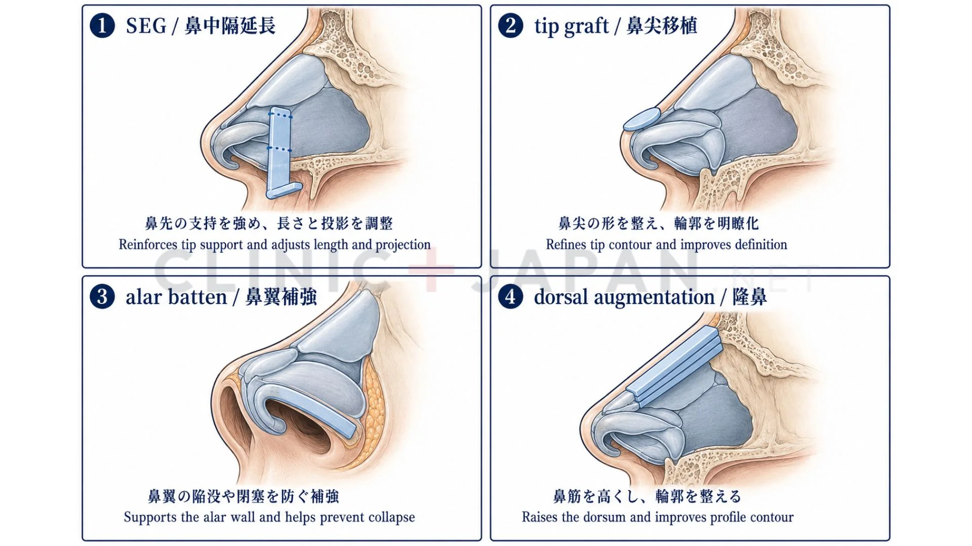 鼻軟骨移植 適応の図解 — SEG・tip graft・alar batten・dorsal augmentationの使い分け