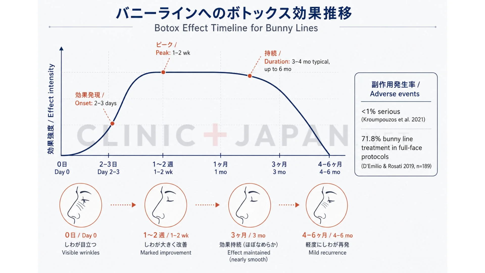 バニーライン ボトックス注入点 — 横鼻筋・LLSAN・procerus・内側眼輪筋への用量と注入位置