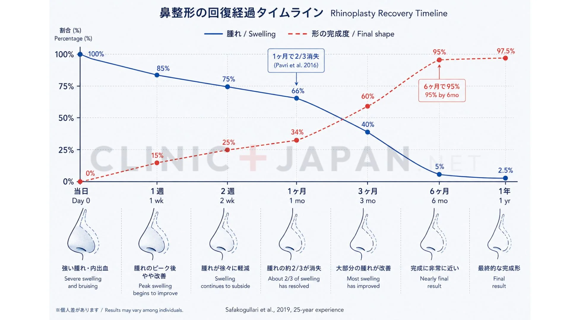 鼻整形の経過 時系列チャート — 1ヶ月66%・6ヶ月95%・1年97.5%の浮腫消失データ
