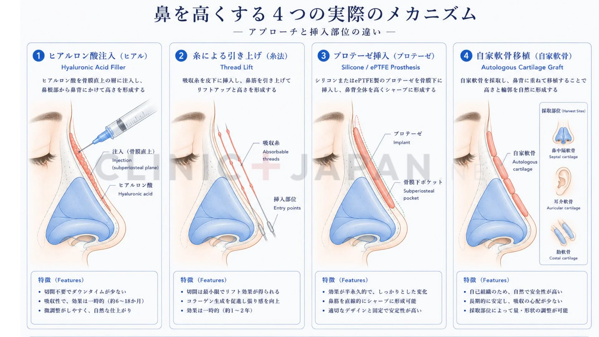 プロテーゼと自家軟骨の手術アプローチ比較