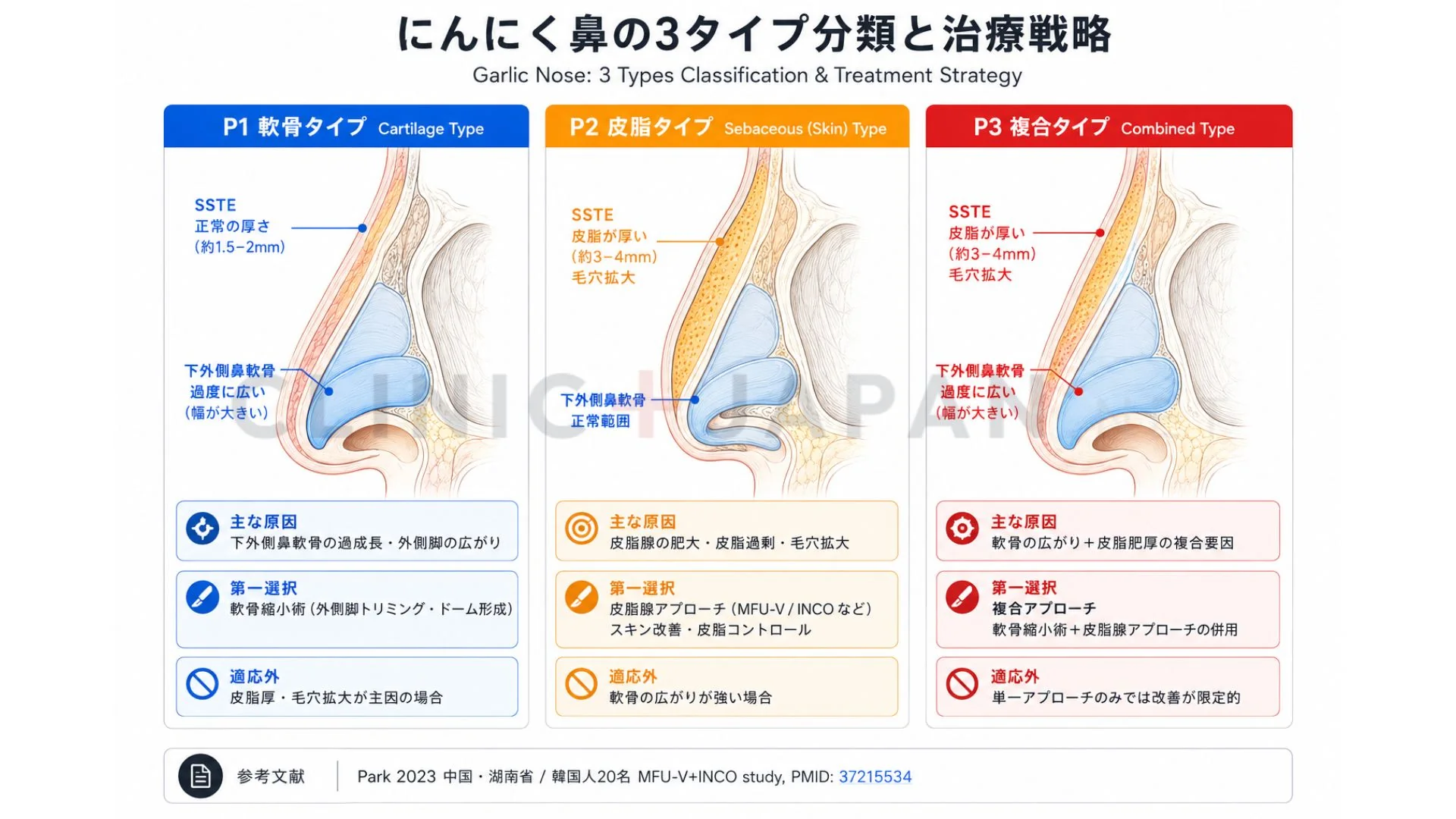 にんにく鼻の3タイプ — 軟骨タイプ・皮脂タイプ・複合タイプの特徴比較