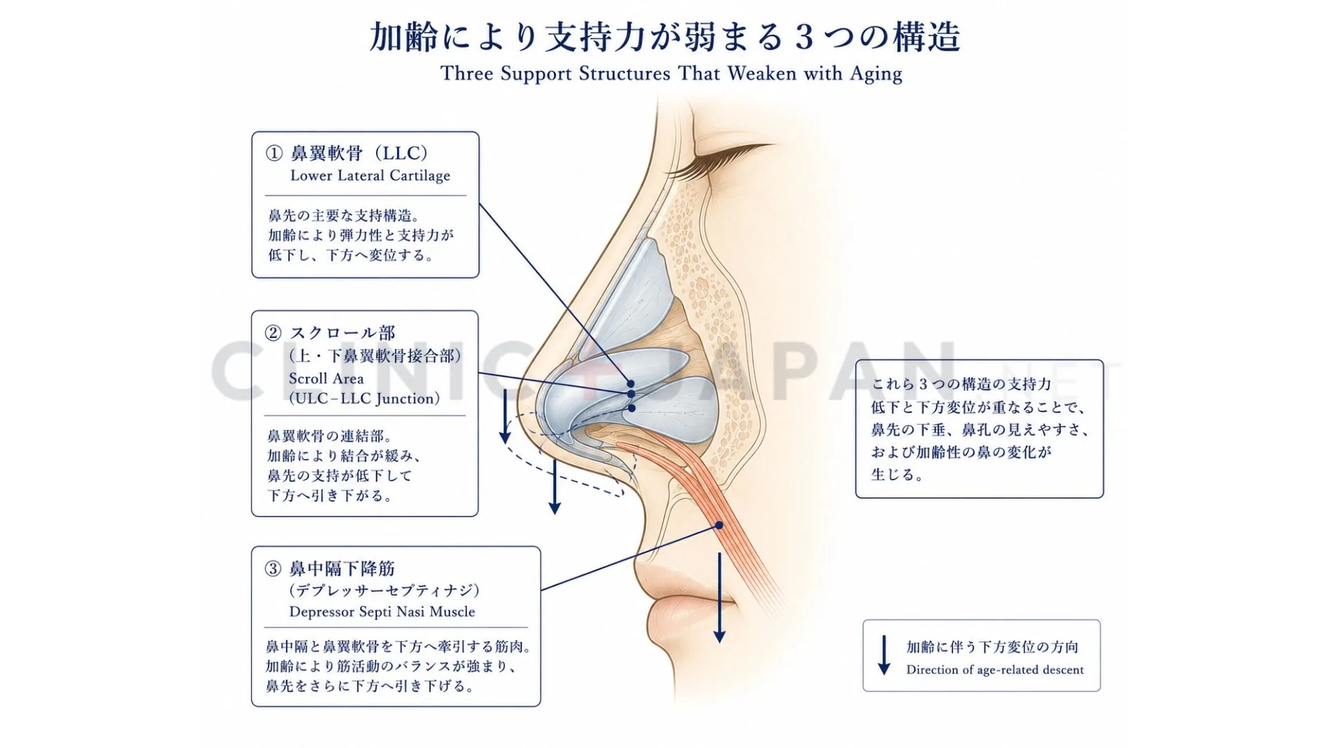 垂れ鼻の解剖図 — 加齢で下垂する3つの支持構造（鼻翼軟骨・スクロール領域・depressor septi筋）