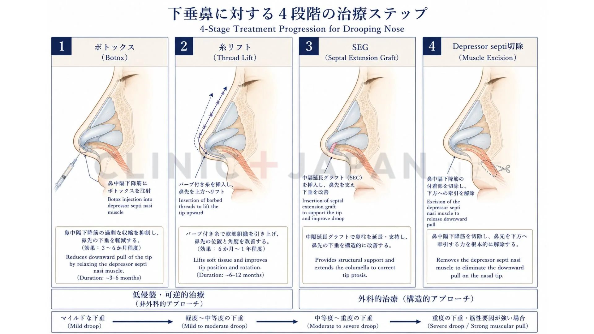 垂れ鼻の改善法4段階 — ボトックス・糸・SEG・depressor septi切除の比較