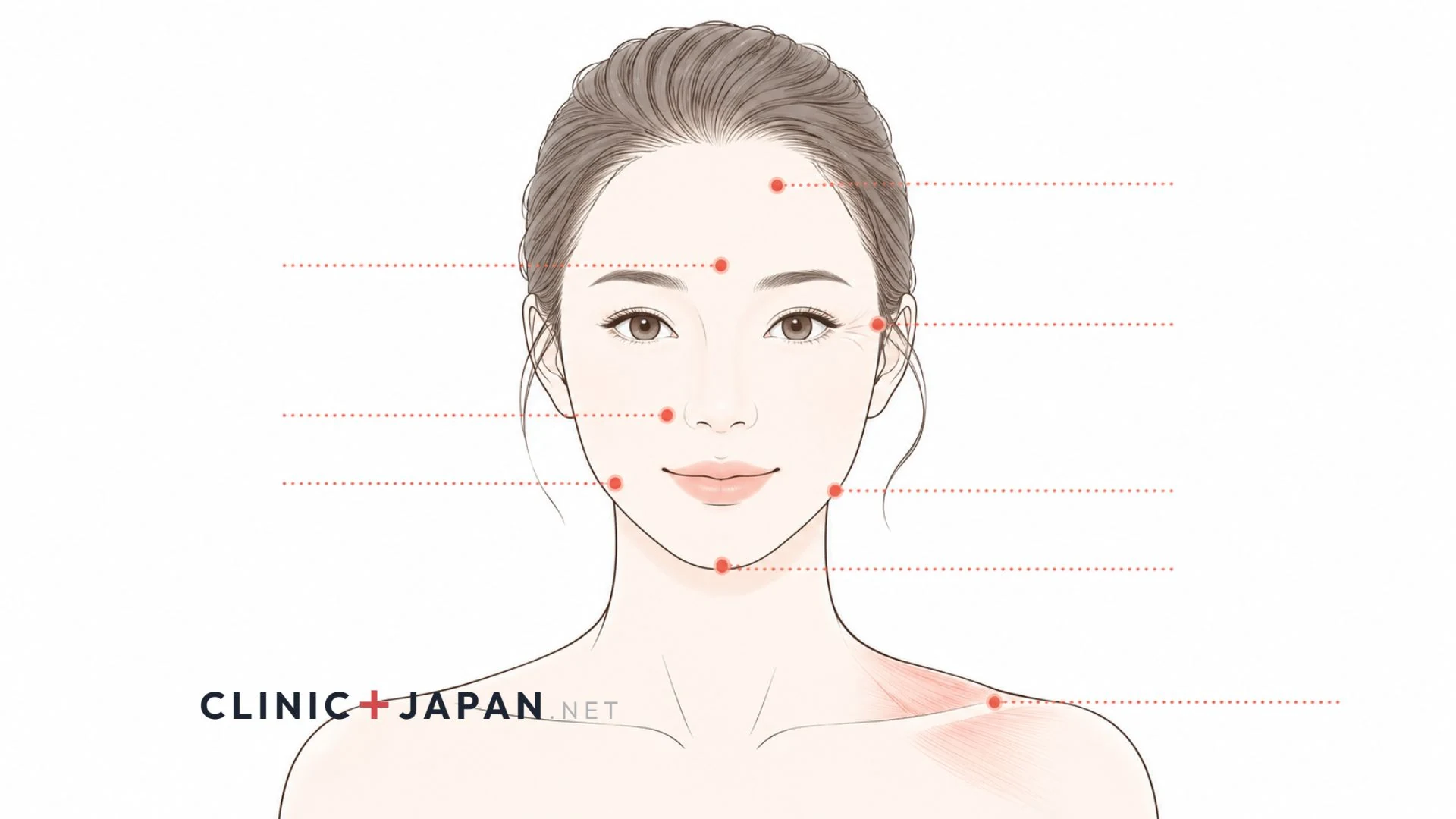 ボトックス施術部位マップ — 顔・首・肩の主要8カ所