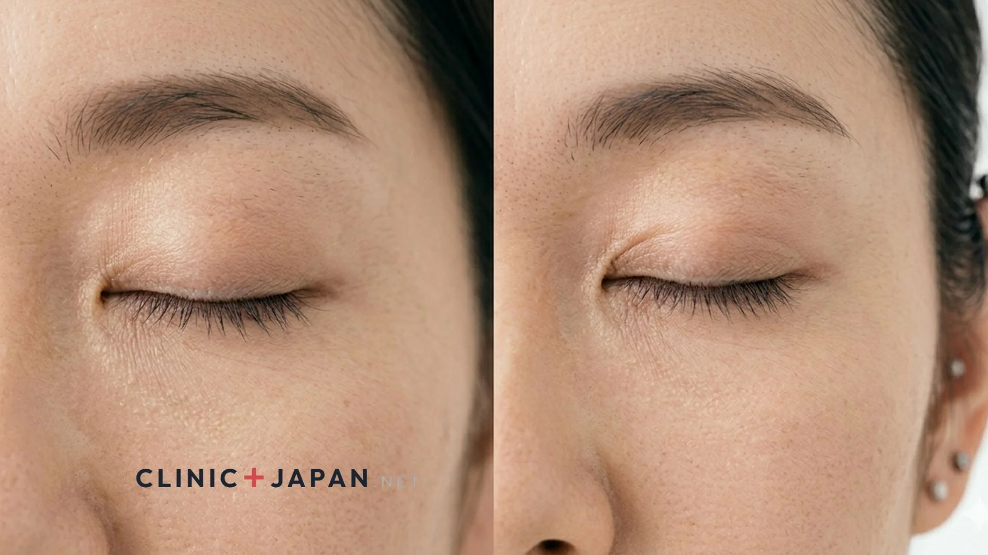 二重整形のシミュレーション — ラインの幅と形を医師と詰める工程