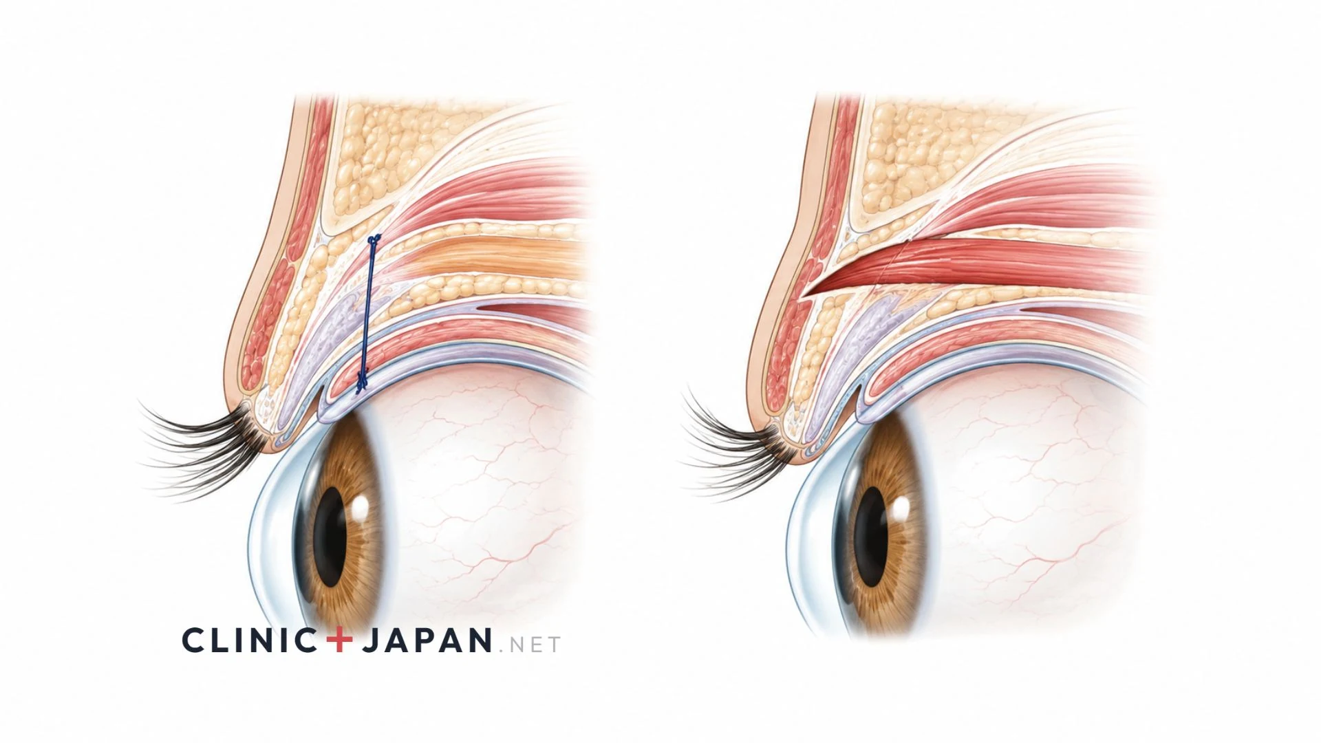 二重ラインの3タイプ — 末広型・平行型・ミックス型の比較