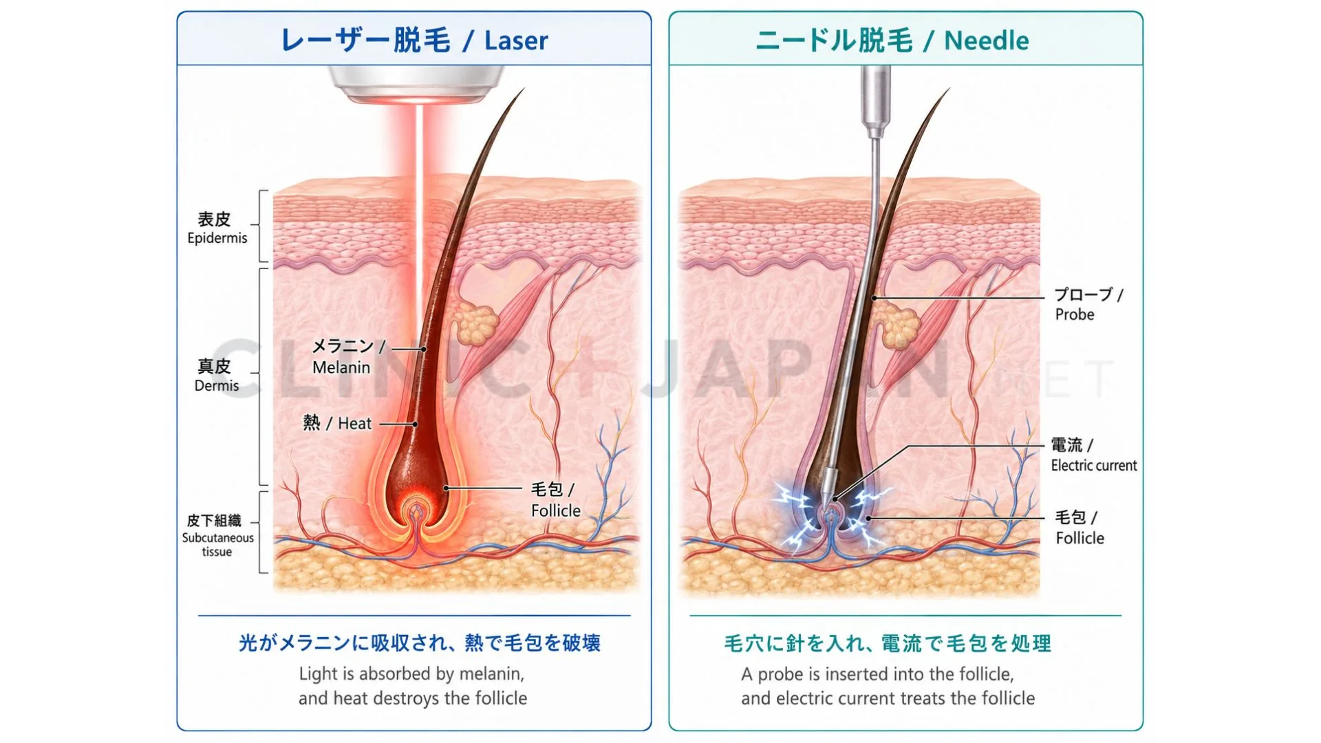 永久減毛のメカニズム — 毛乳頭・毛母細胞・バルジ領域へのレーザー作用と、毛根破壊による再生抑制の仕組み