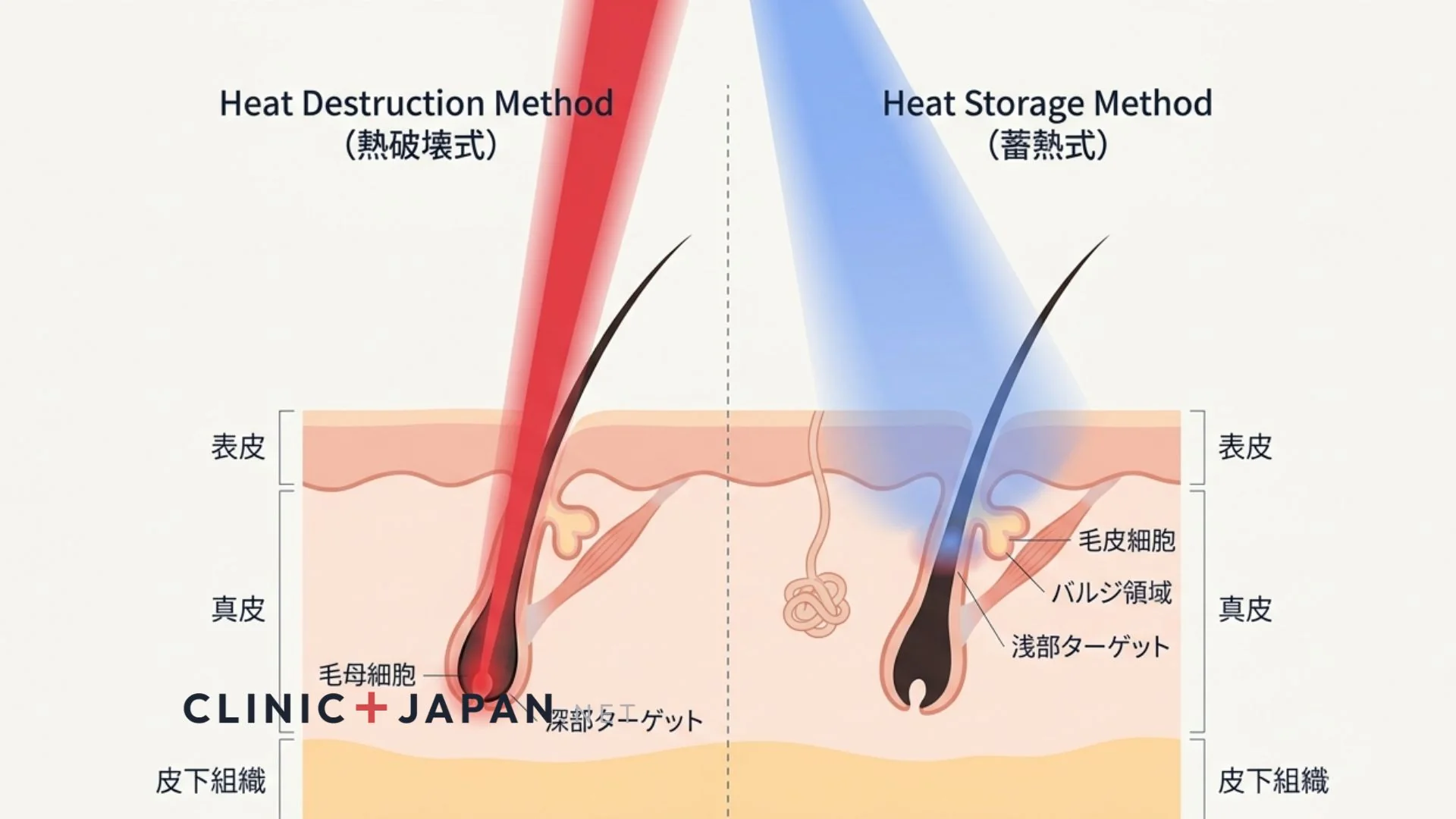 顔脱毛の機種比較イメージ — 蓄熱式と熱破壊式の違い