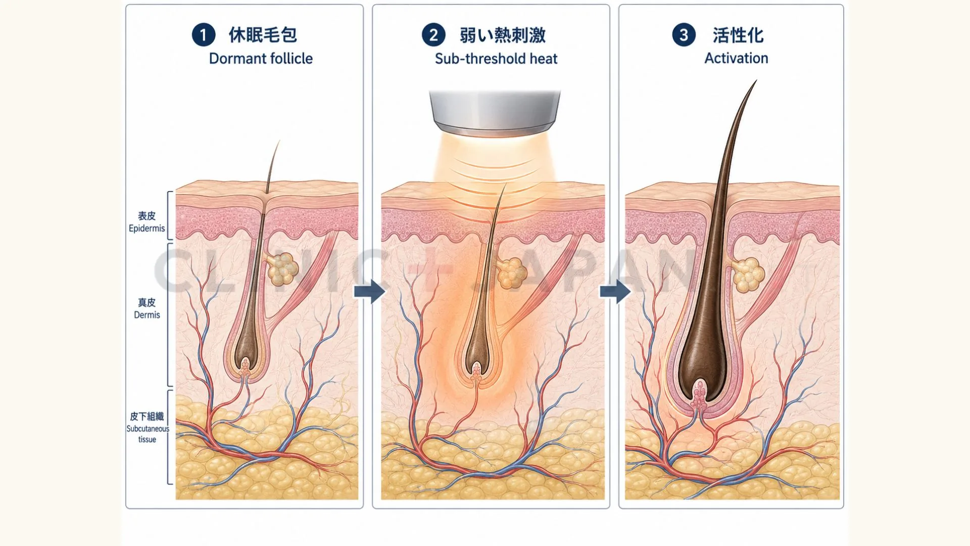 硬毛化のメカニズム — サブセラピューティック熱刺激による休眠中毛包の活性化と、顔・首での好発理由