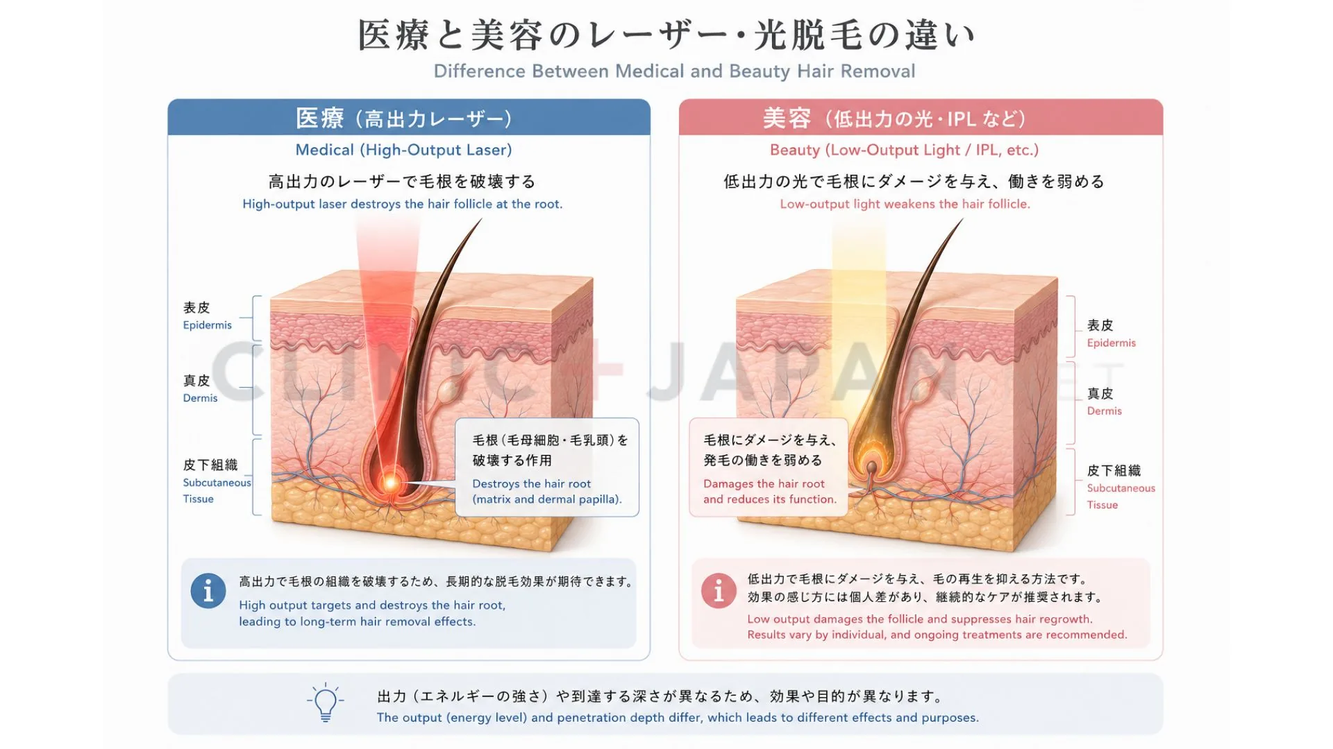医療脱毛と美容脱毛のメカニズム比較 — 高出力レーザーによる毛乳頭・毛母細胞の破壊と、低出力光による毛成長の一時的な抑制の違い